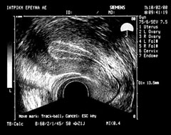 Ultrasound monitoring of endometrium thickness, during multiple follicle development treatment. The picture demonstrates a triple-line pattern, with 13.5 mm thickness and a visible cervix. (EUGONIA archive)